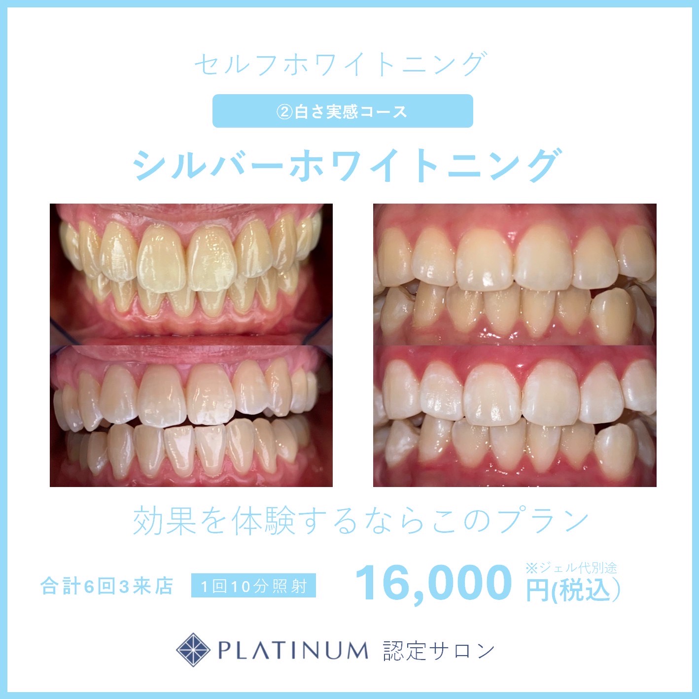 シルバーホワイトニングのイメージ