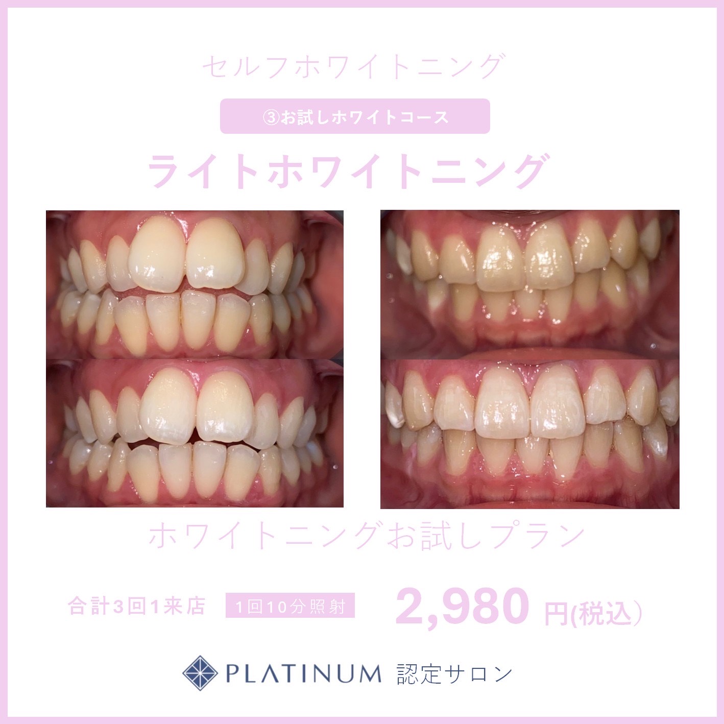 体験ホワイトニングのイメージ